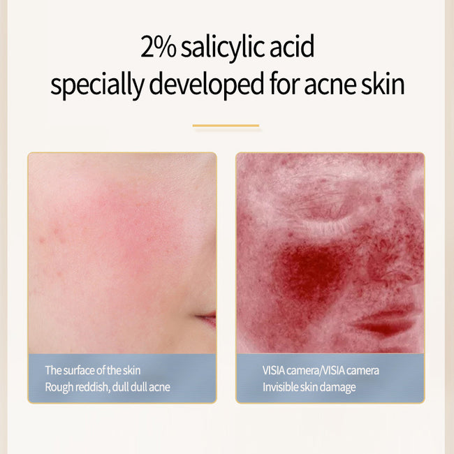 Acne Removing Salicylate Products Main Image